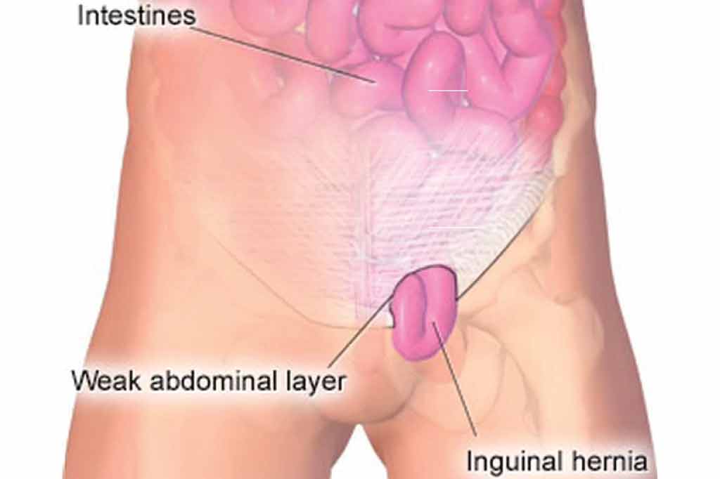 Inguinal Hernia Introduction