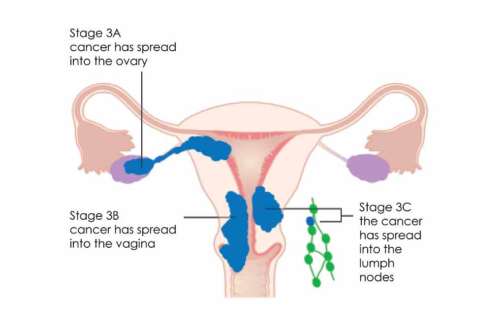 endometrial Ca, malignant endometrial neoplasm, neoplasm of endometrium (disorder), endometrial neoplasm, malignant neoplasm of endometrium, primary malignant neoplasm of endometrium, tumor of Endometrium,uterine cancer, endometrial cancer, Uterine (uterus) cancer,