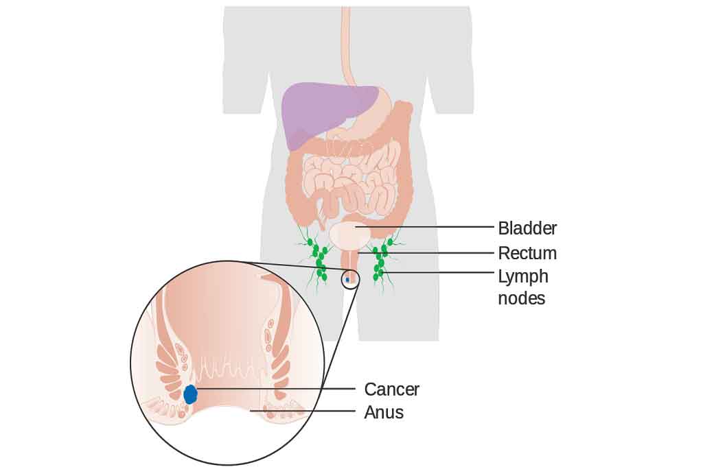 anal cancer, malignant anal tumor,anus cancer,